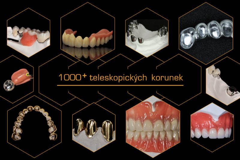 Teleskopické korunky 1000 +