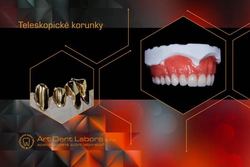 Teleskopické korunky – snímatelné náhrady